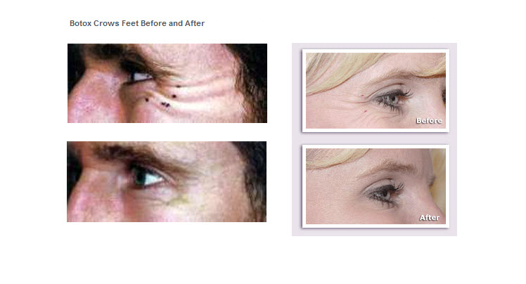 Botox Crows Feet