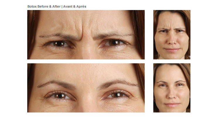 Botox Frown Lines