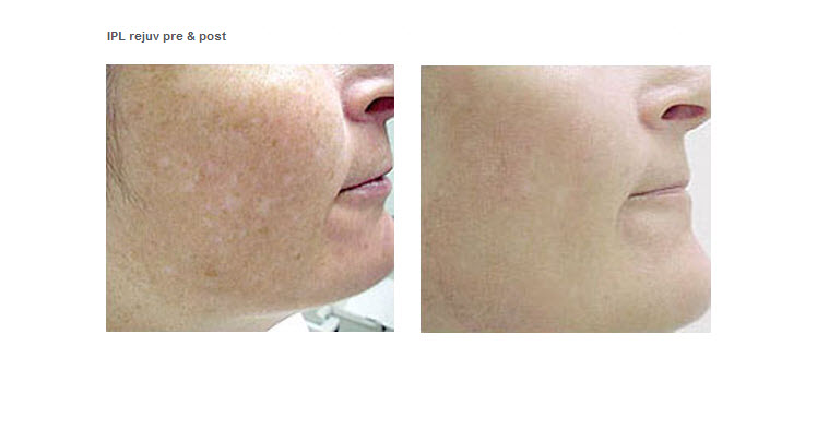 IPL rejuv pre and post
