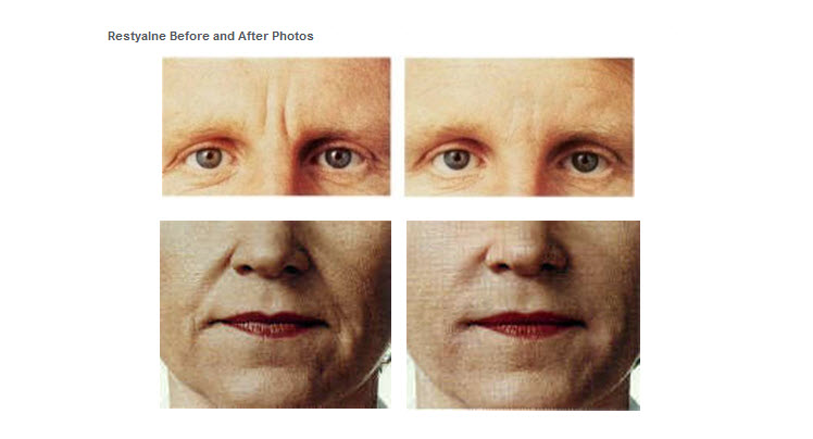 Restyalne Before and After