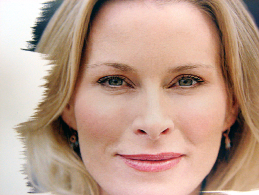 botox_woman